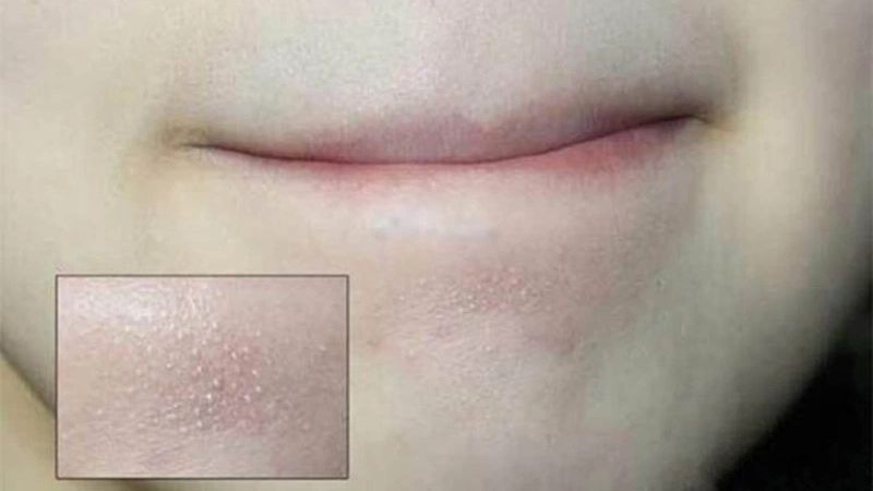 Mụn ẩn dưới cằm