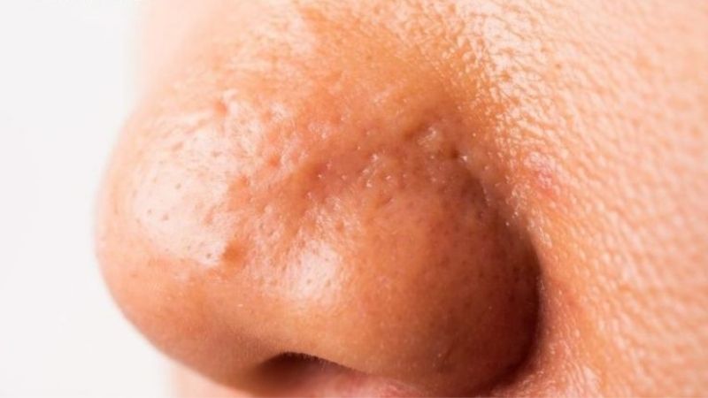 Mụn ẩn ở mũi 
