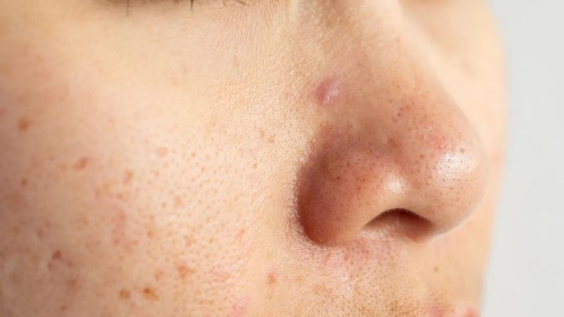 Mụn ẩn ở mũi do đâu