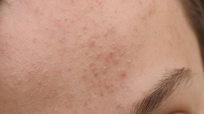 Mụn ẩn trên trán