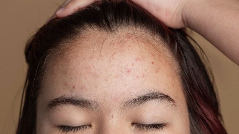 Nguyên nhân gây mụn ẩn trên trán