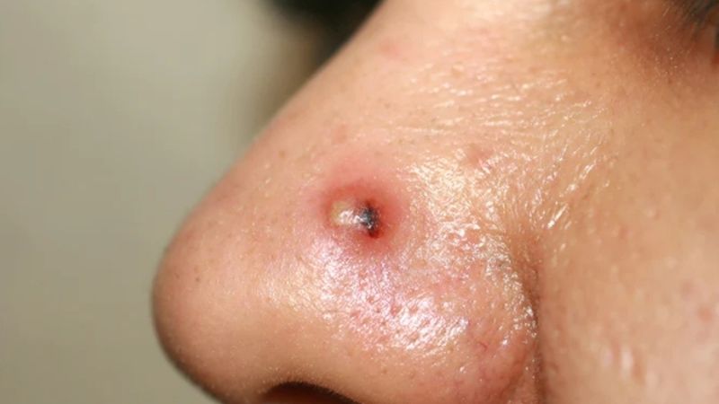 Mụn bọc bao lâu thì chín? Từ 5 - 7 ngày