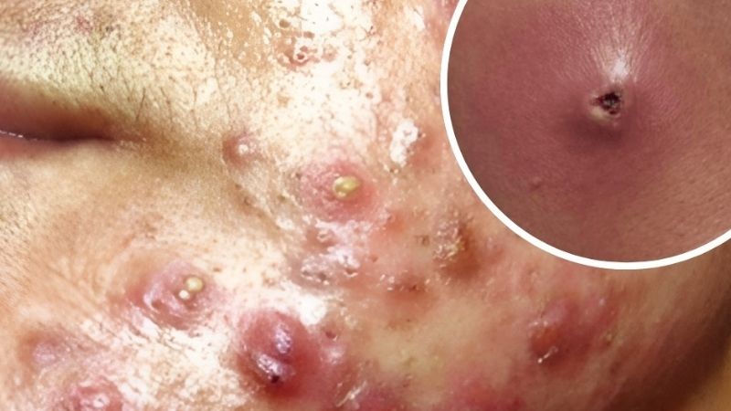 Mụn bọc đã chín