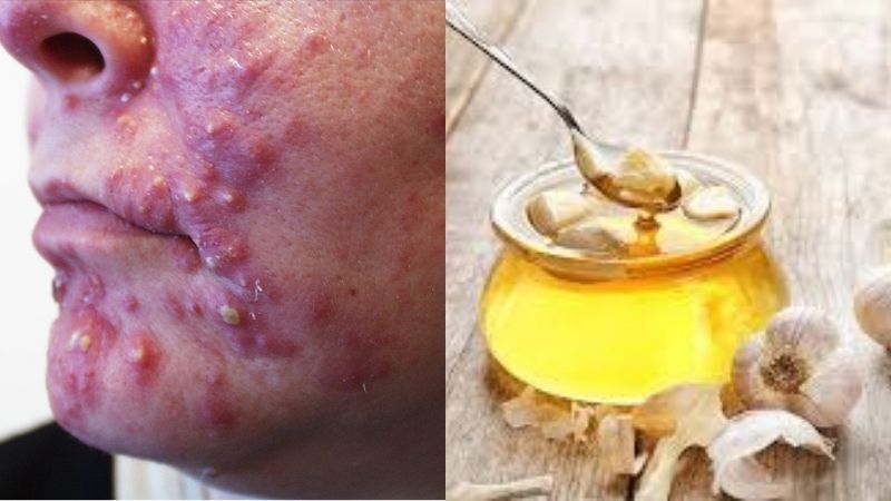 Cách làm mụn bọc mau chín bằng tỏi tươi