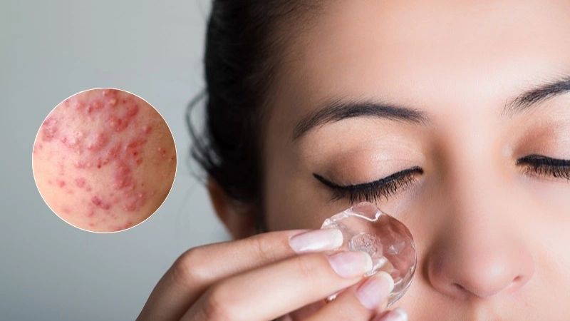 Chườm đá giúp mụn bọc nhanh chín