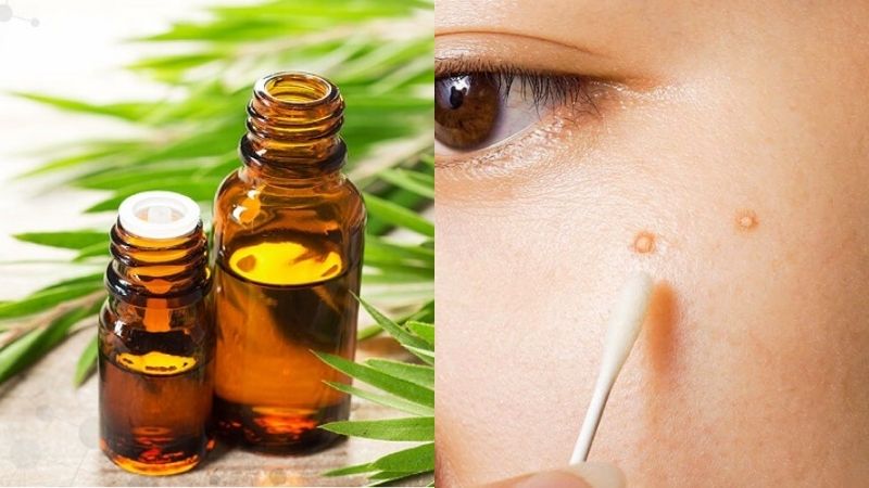 Cách làm mụn bọc mau chín bằng tinh dầu tràm trà