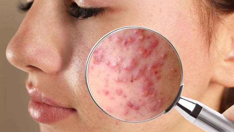 Mụn bọc có thể tự xẹp không? Mụn bọc không nặng có tự hết không