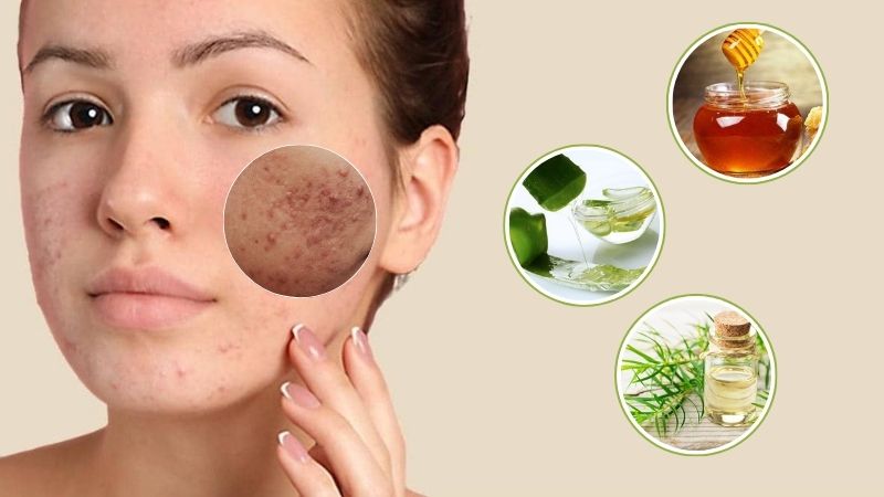 Cách làm mụn bọc nhanh xẹp