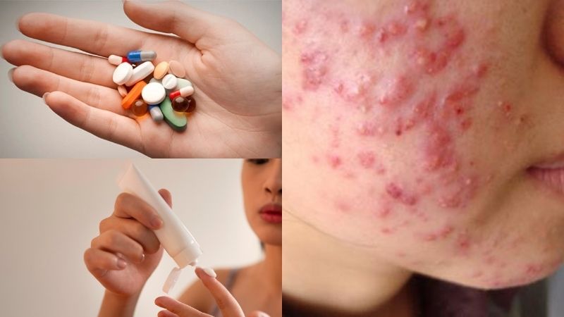 Cách làm mụn bọc nhanh xẹp bằng thuốc