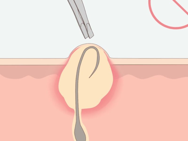 Mụn bọc ở cằm vì lông mọc ngược