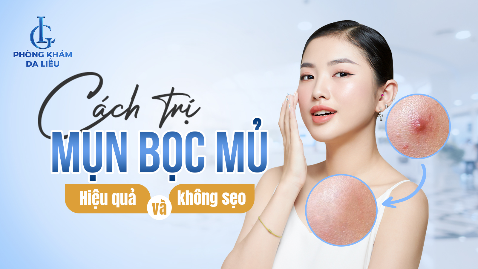 Mụn bọc mủ