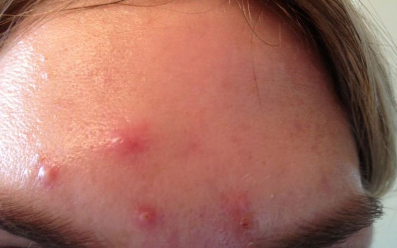 Nguyên nhân gây mụn bọc ở trán