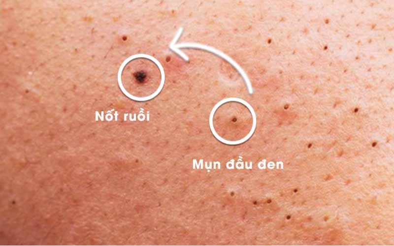 Mụn đầu đen có thành nốt rùi không