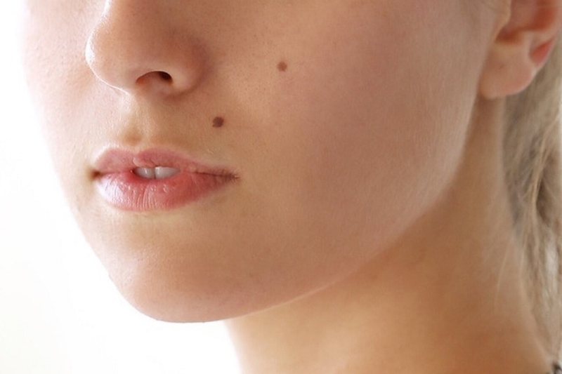 Mụn đầu đen có thành nốt ruồi không