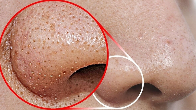 Mụn đầu đen biến thành nốt ruồi không