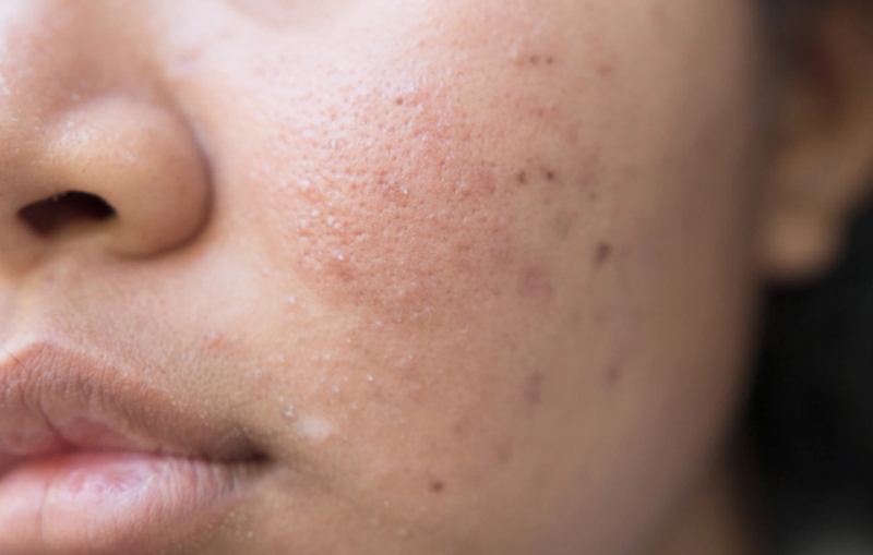 Mụn đầu đen có tự hết được không