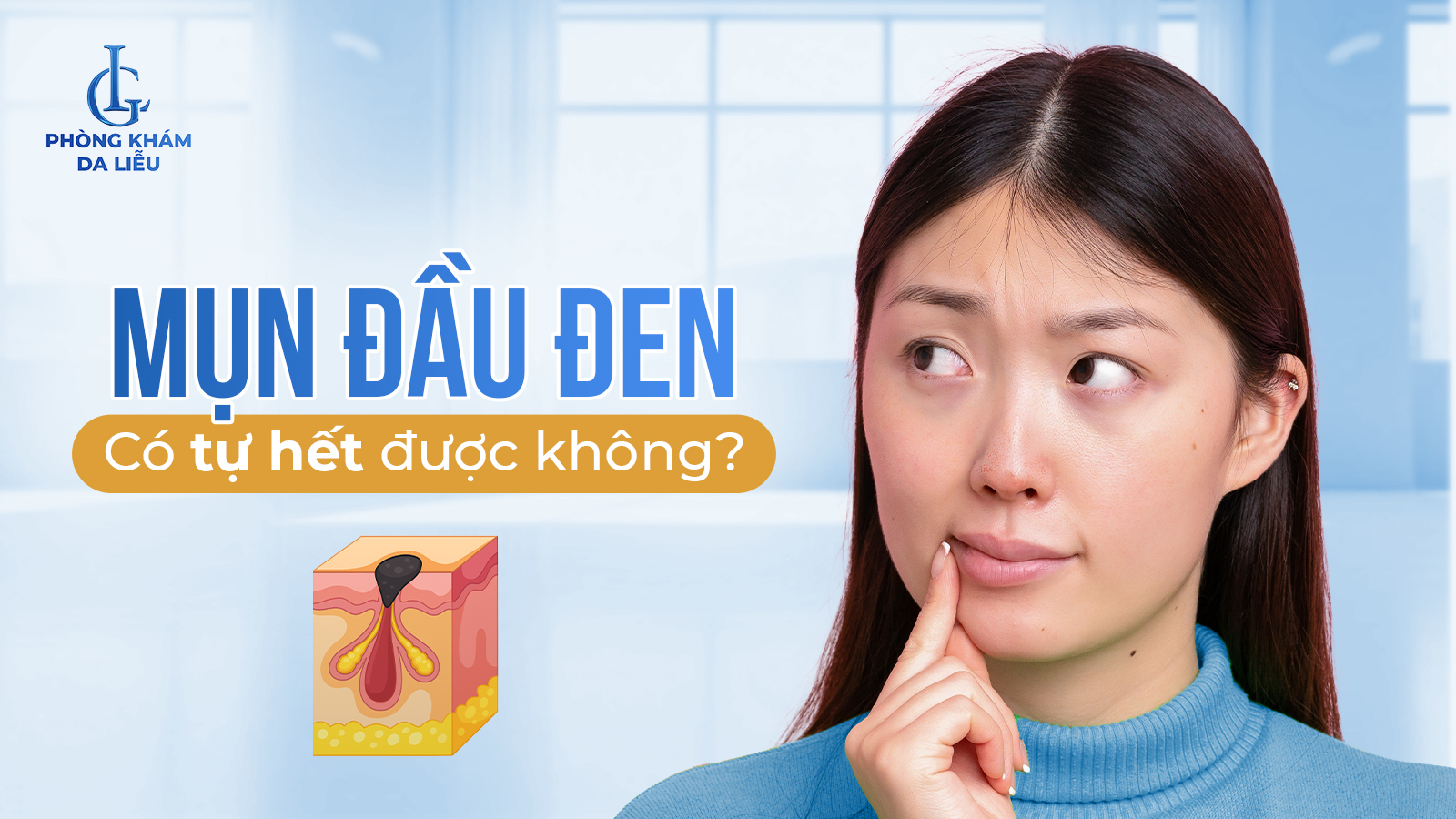 Mụn đầu đen có tự hết được không