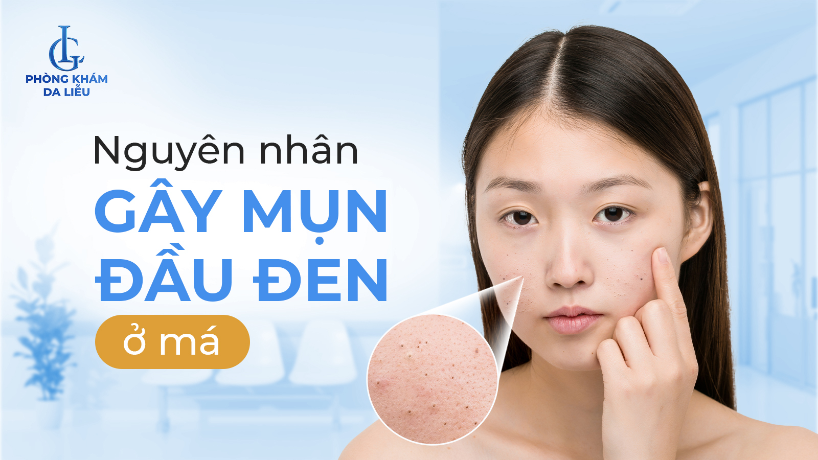 Mụn đầu đen ở má