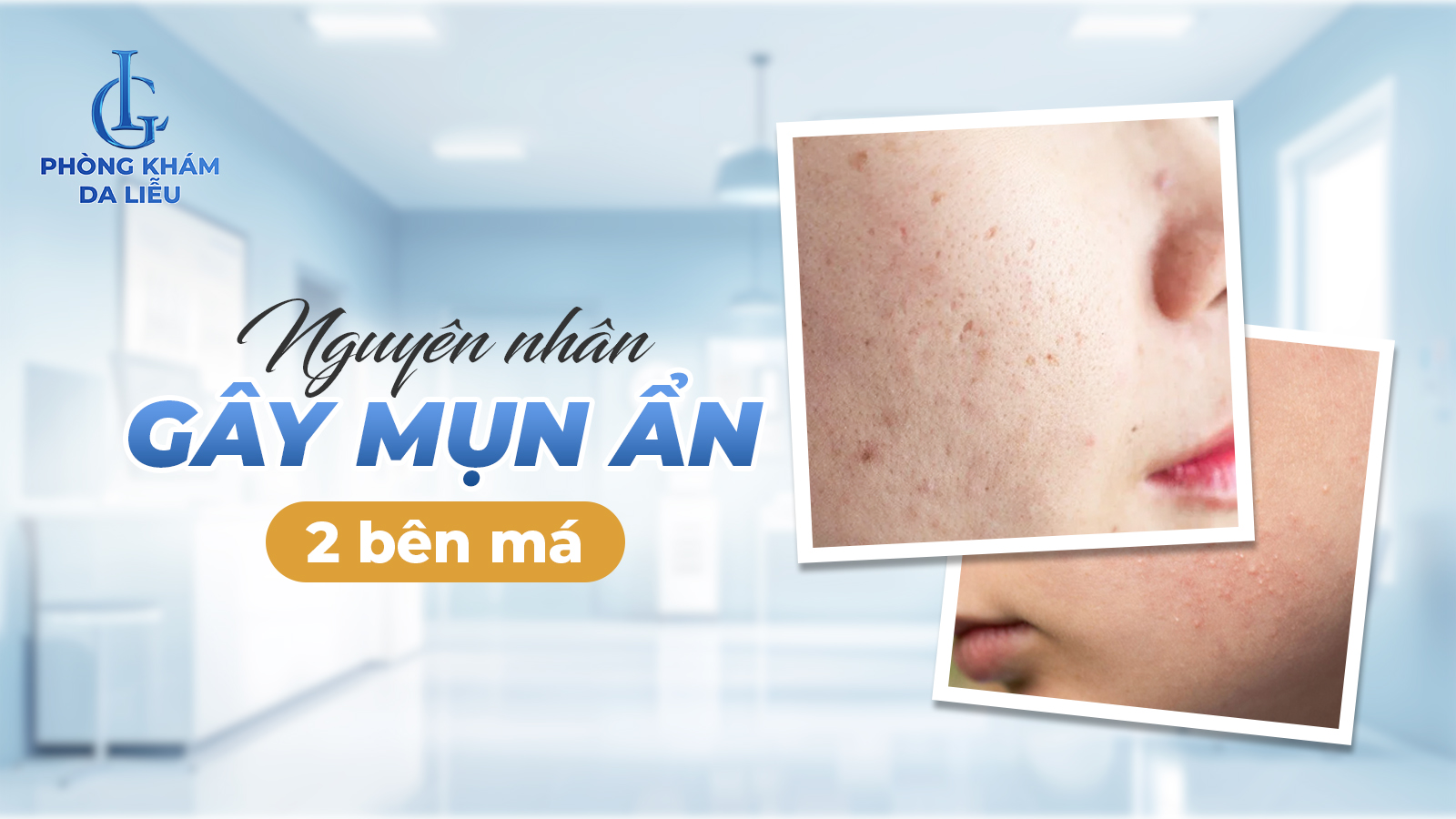 Mụn ẩn 2 bên má