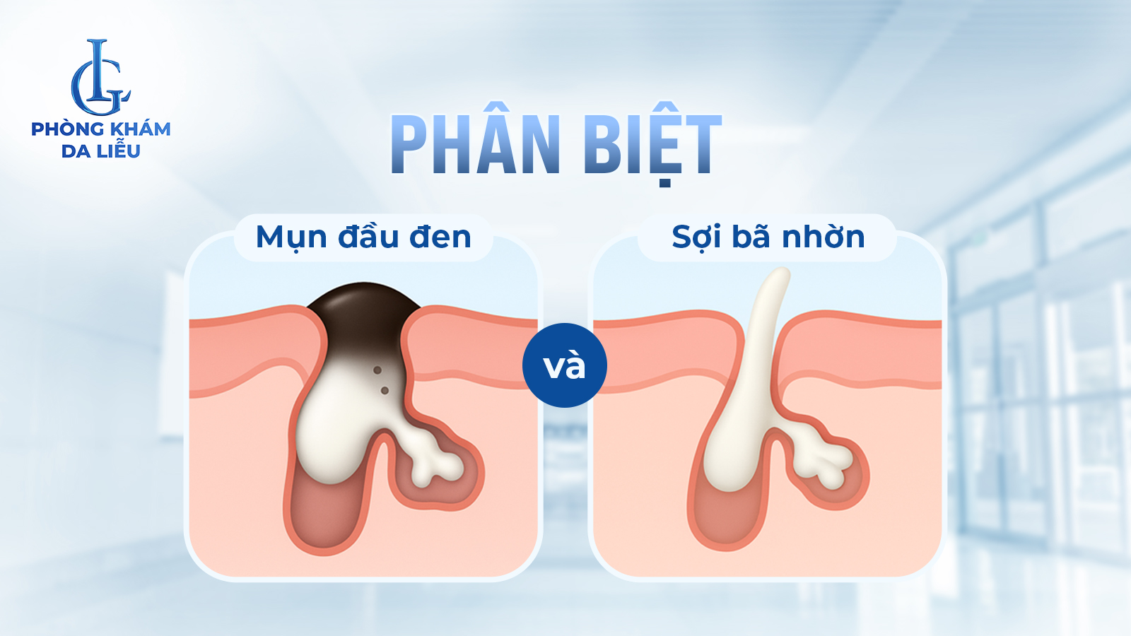 Phân biệt mụn đầu đen và sợi bã nhờn