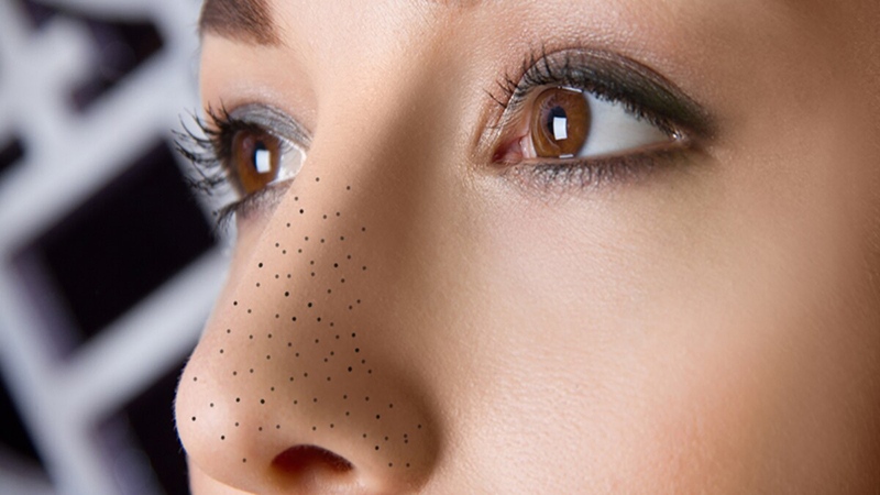 Mụn đầu đen ở mũi