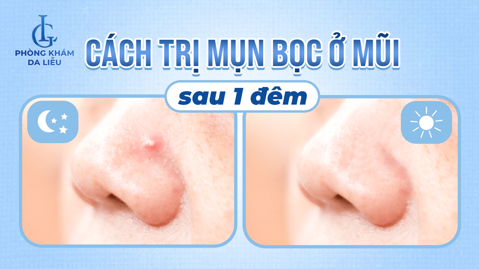 Cách trị mụn bọc ở mũi sau 1 đêm