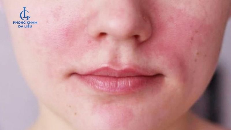 Peel da bị đỏ rát