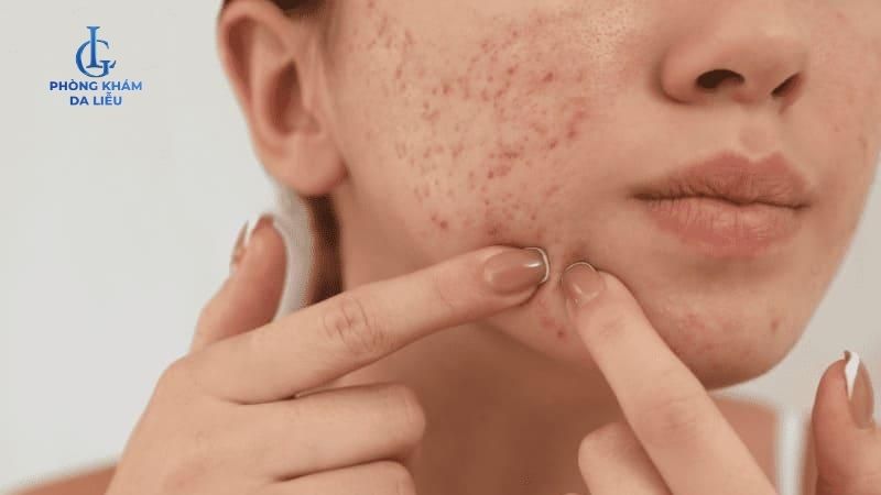 Peel da bị đỏ rát phải làm sao