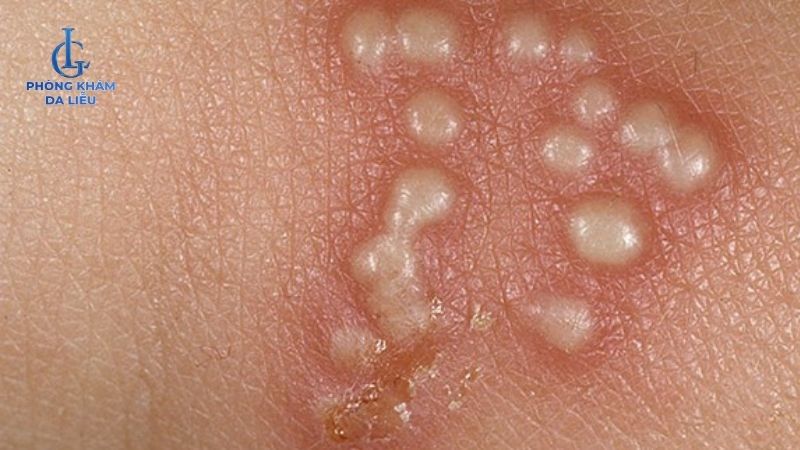 Peel da bị nổi mụn nước