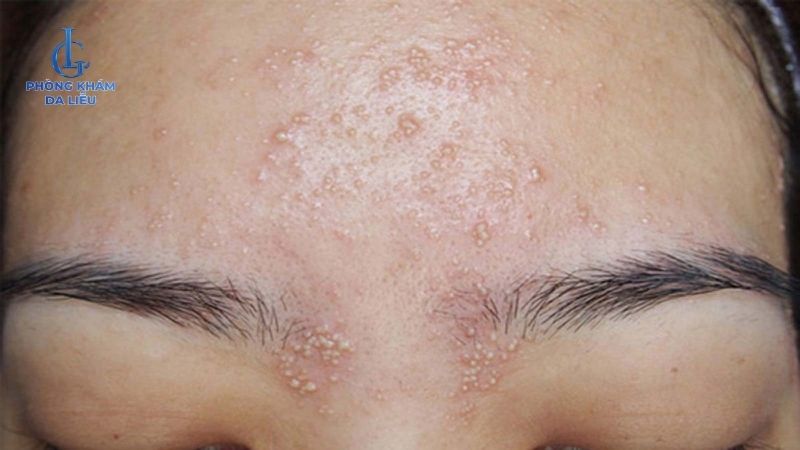 Peel da bị nổi mụn nước