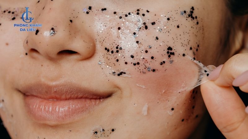 Cách hạn chế peel da bị nổi mụn nước