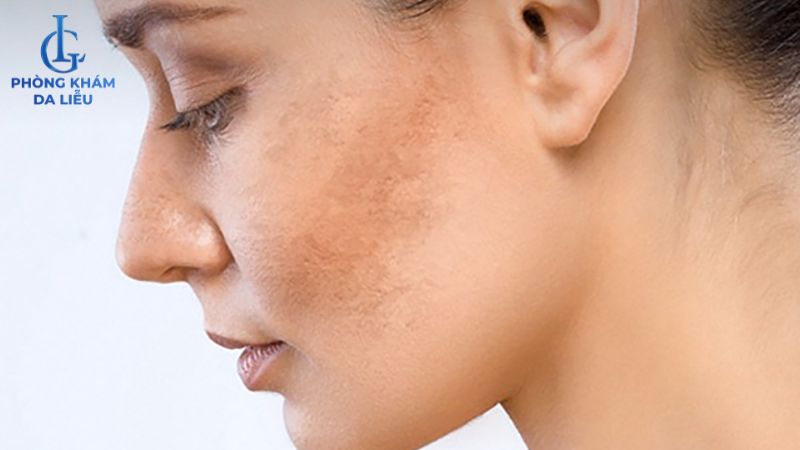 Peel da không bong có tốt không