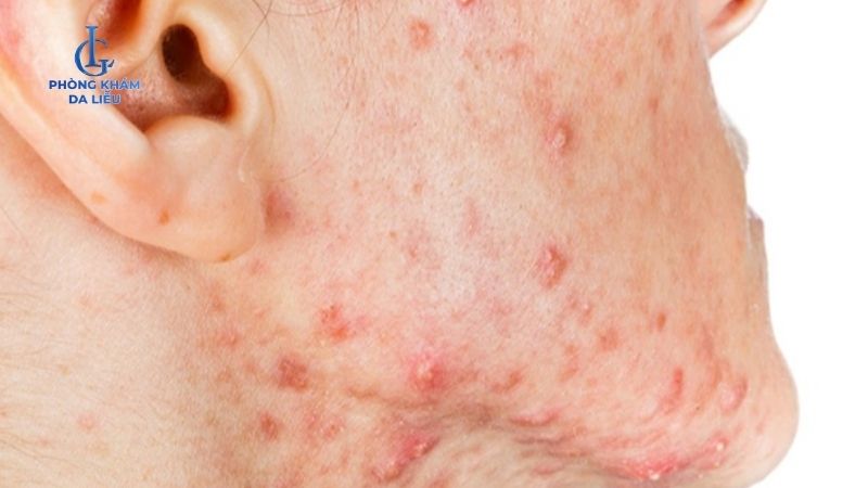 Peel da trị mụn giá bao nhiêu