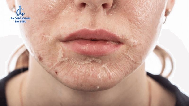 Peel da trị mụn tại nhà