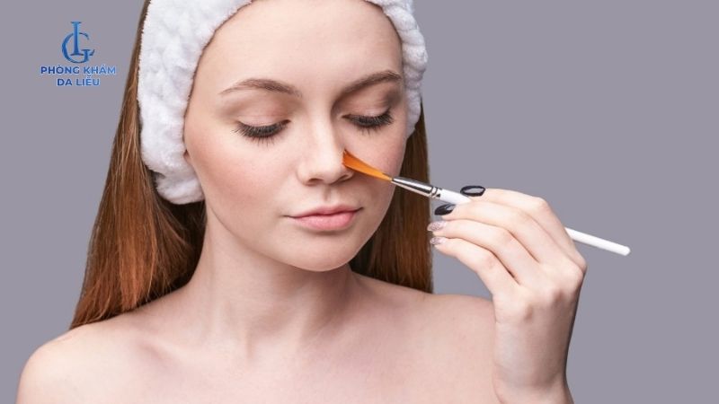 Peel da trị mụn tại nhà