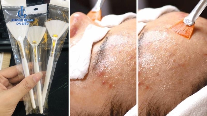 Các bước peel da tại nhà