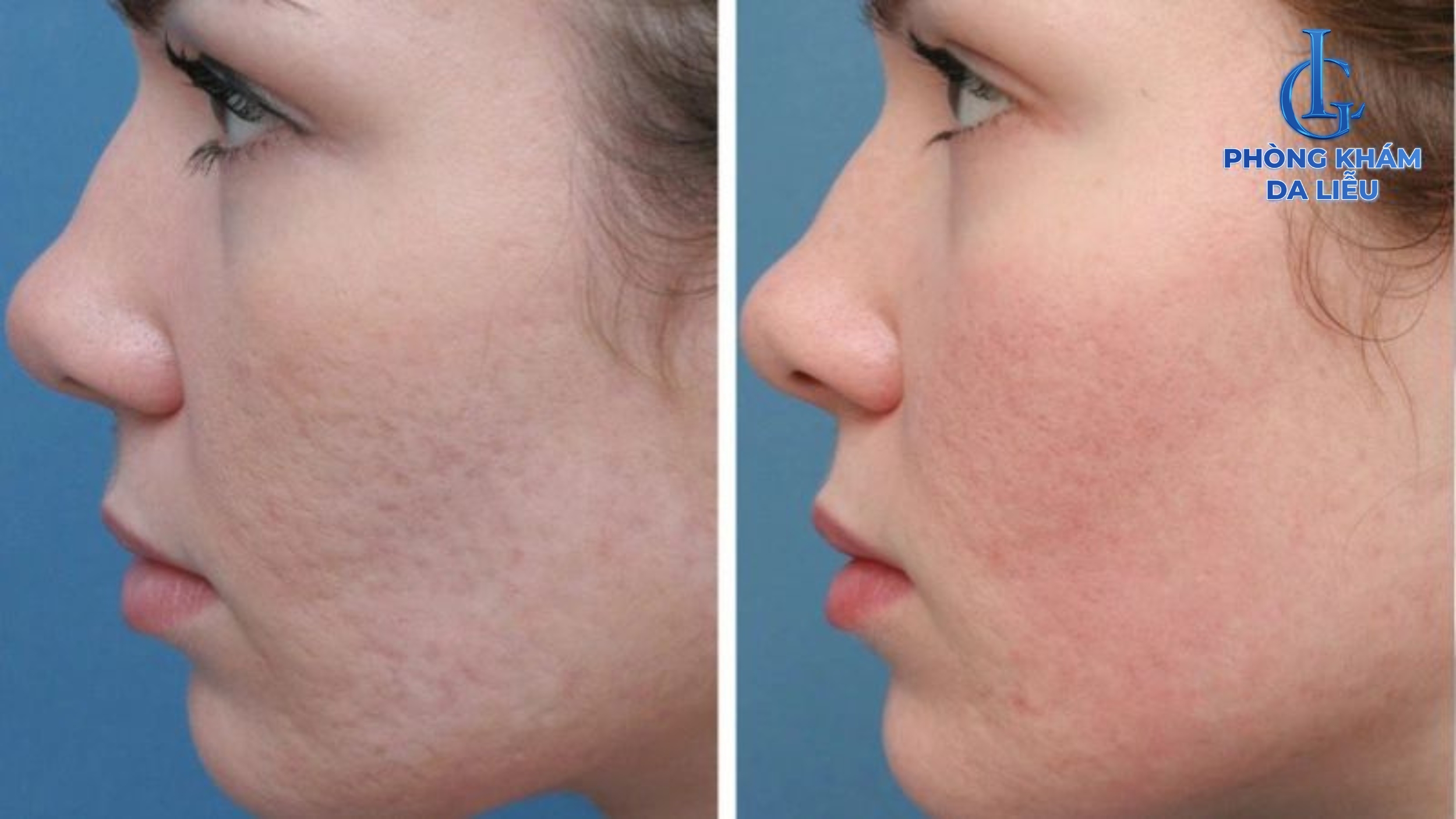 Sẹo rỗ cải thiện