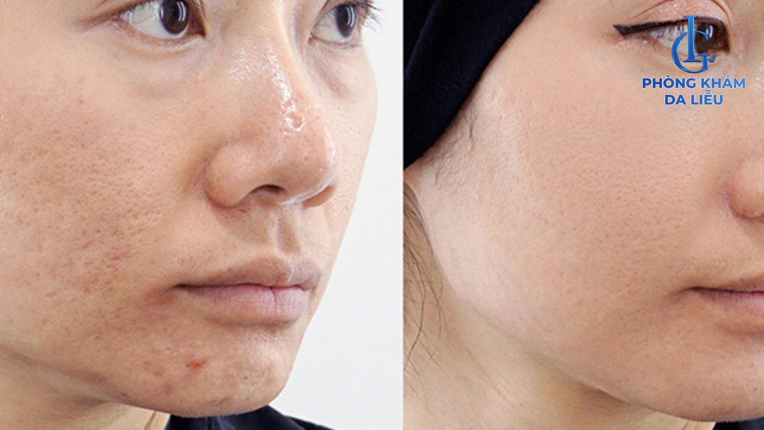 kết quả trị sẹo rỗ