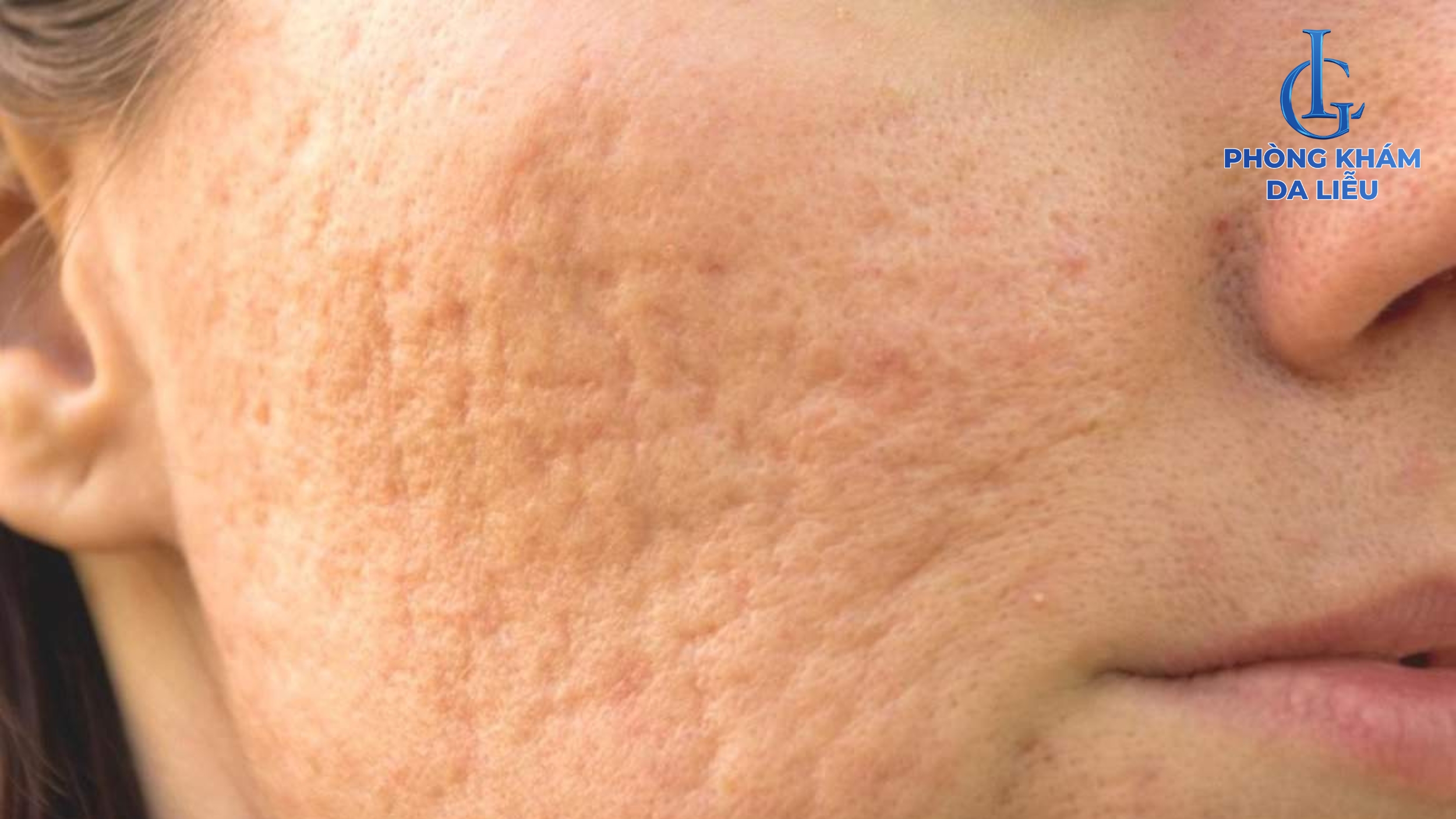 Sẹo lõm lâu năm