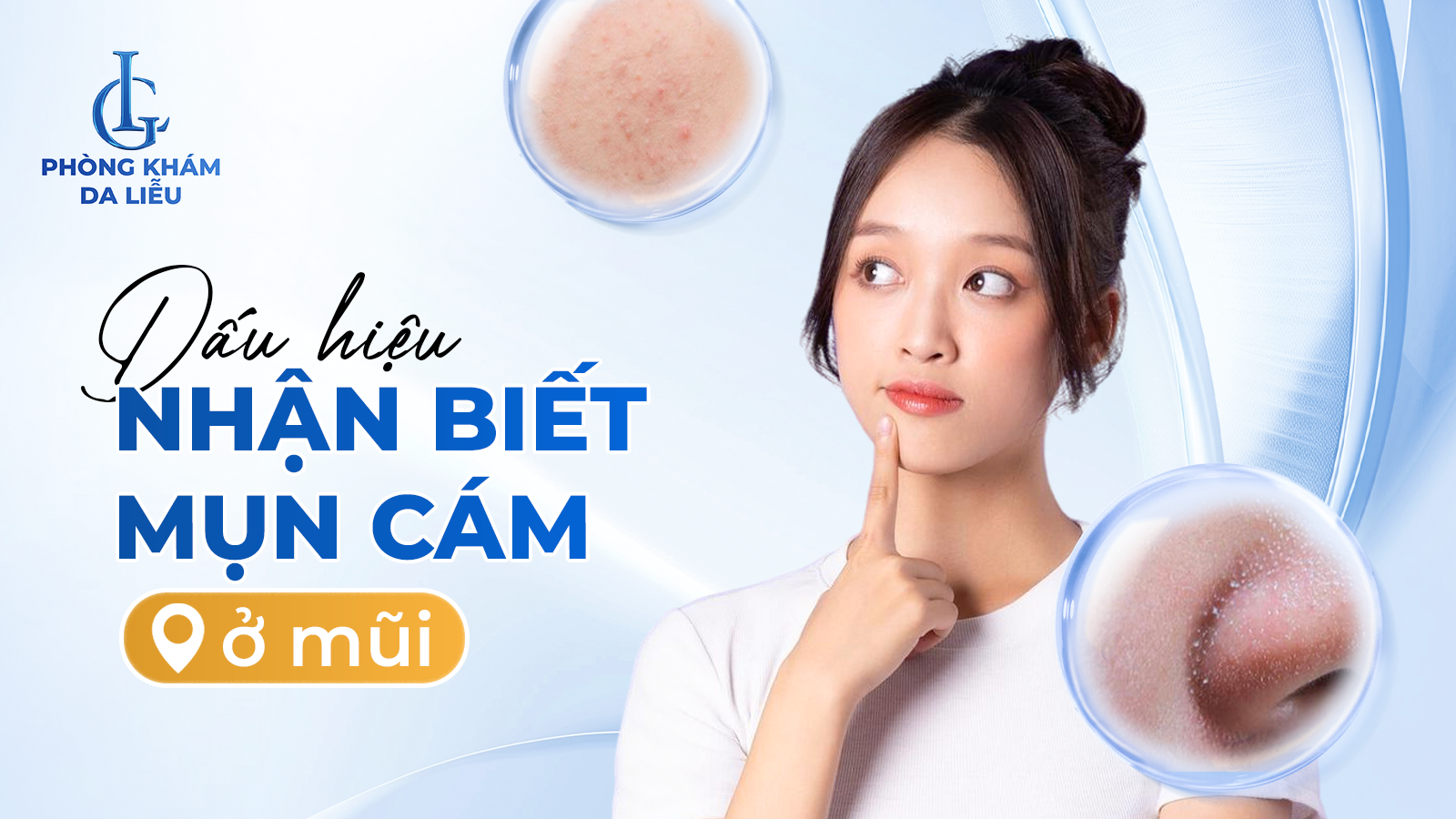 Mụn cám ở mũi