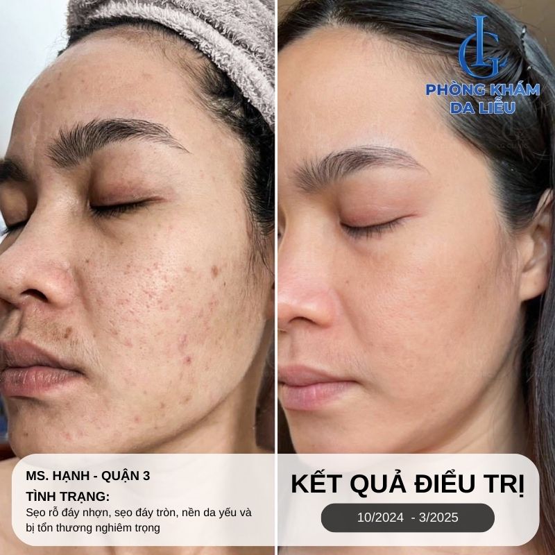 B-A trị sẹo rỗ