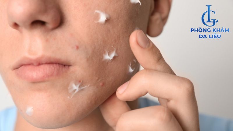 bôi kem trị sẹo