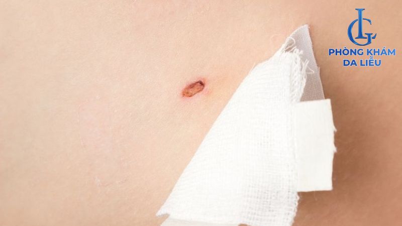 Vết thương sau tẩy nốt ruồi