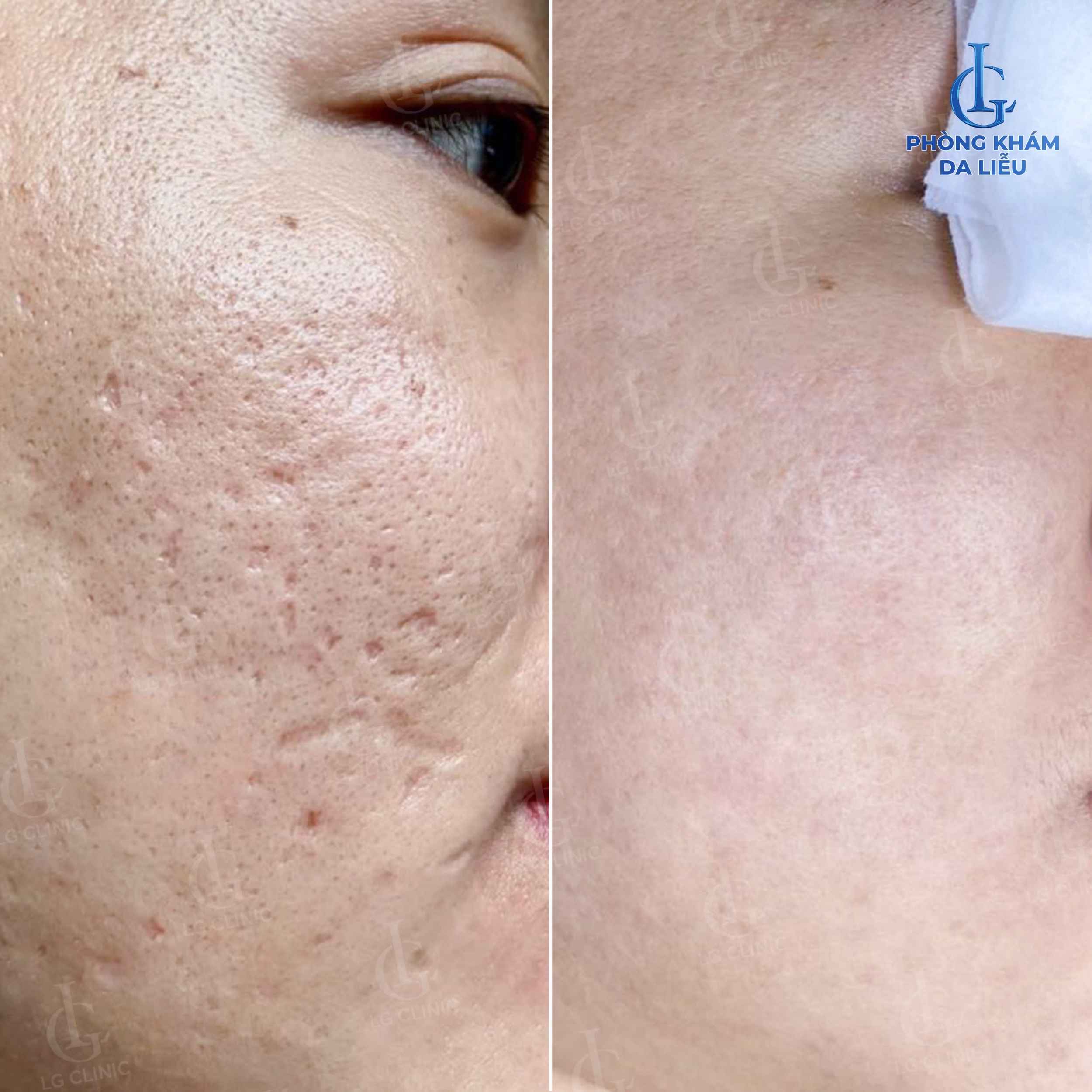 hiệu quả trị sẹo rỗ