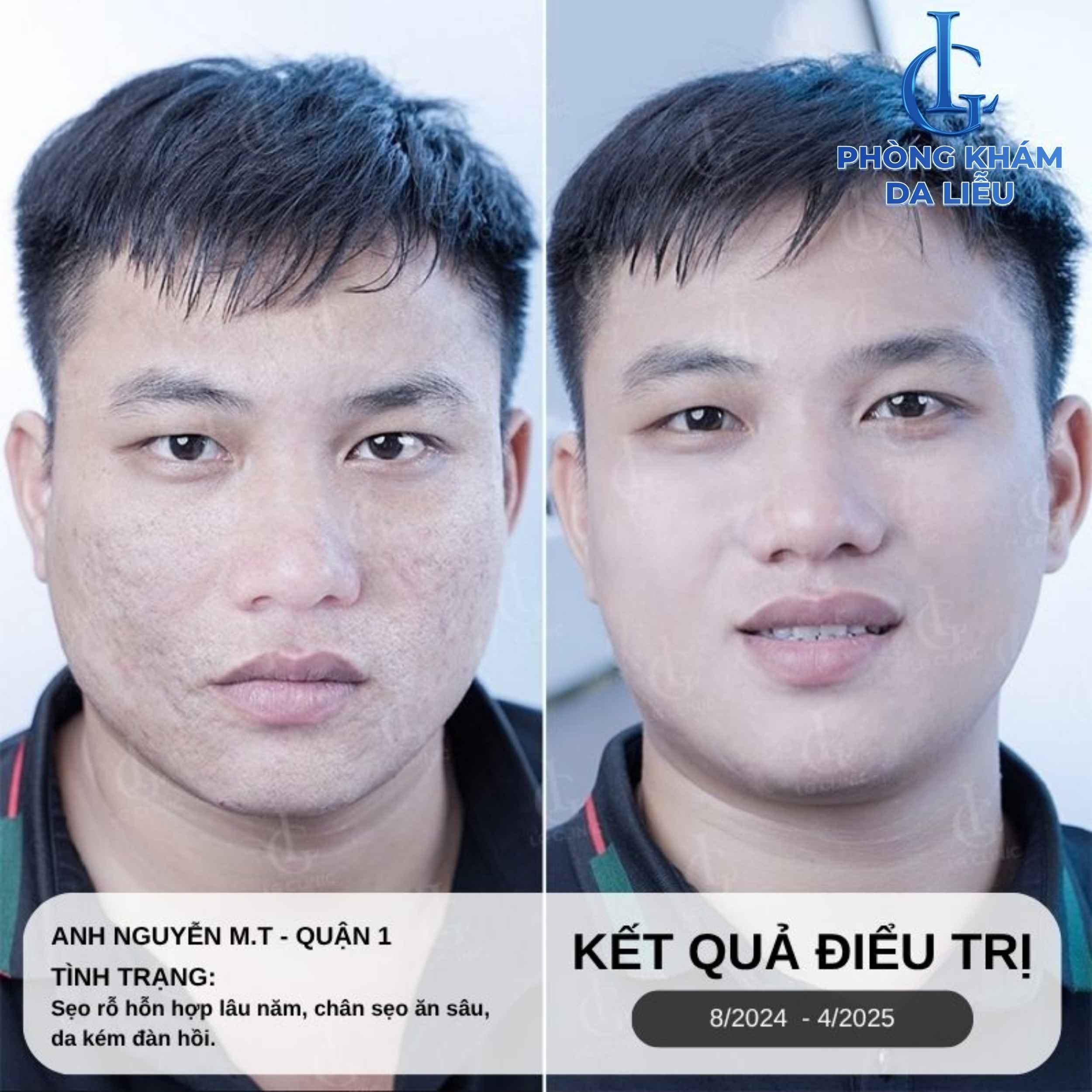 B-A trị sẹo rỗ