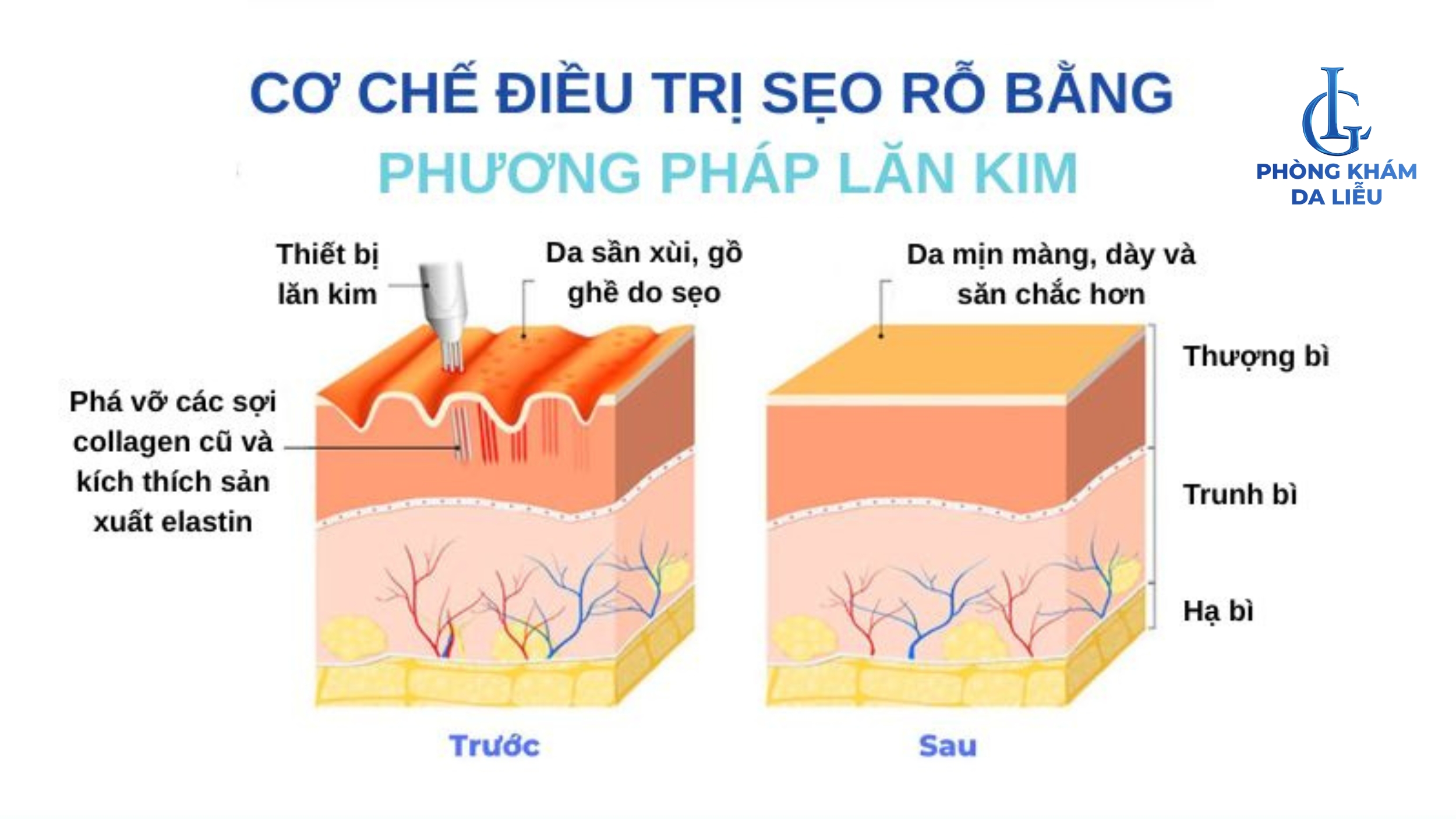 lăn kim trị sẹo rỗ
