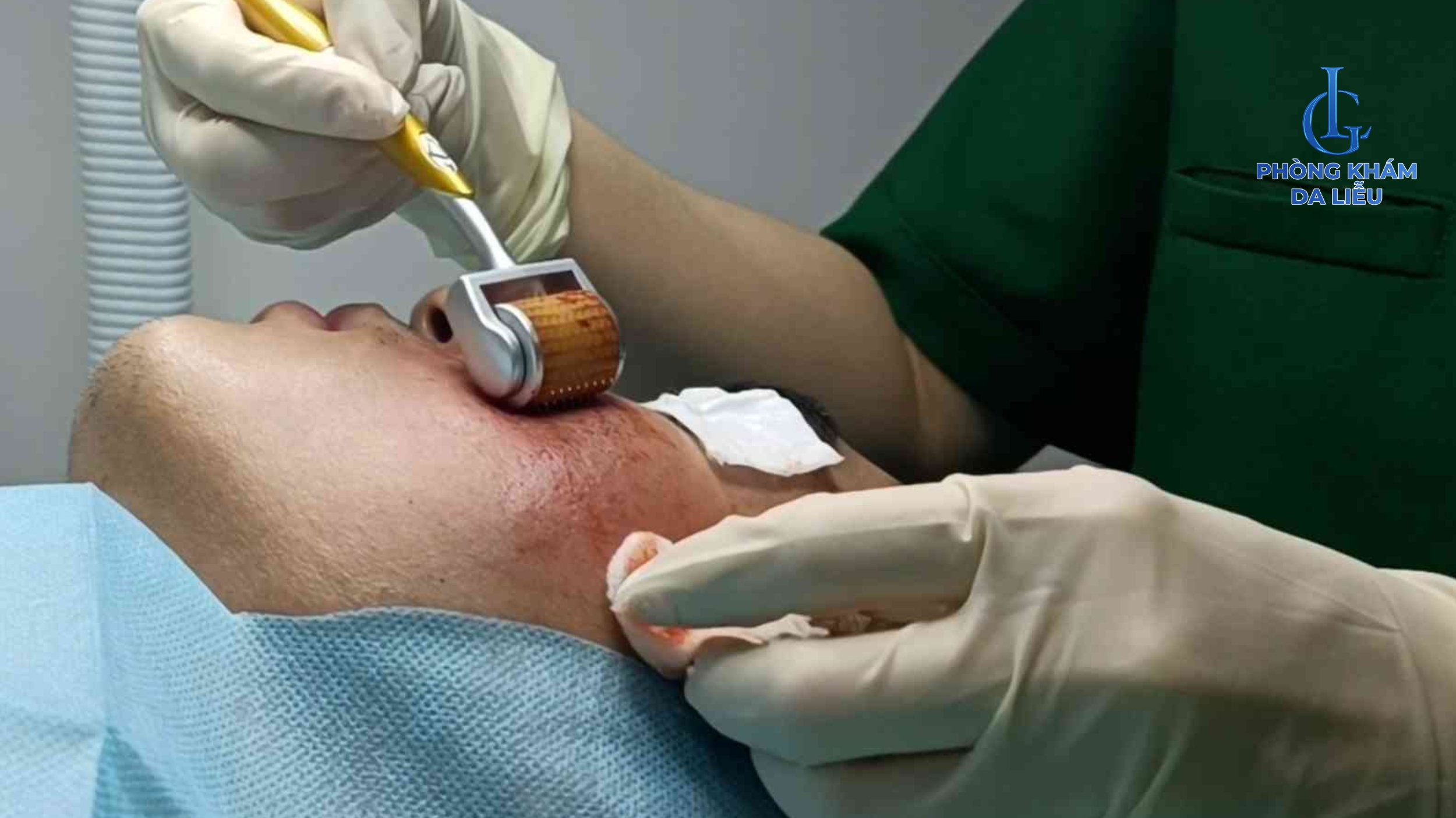 Lăn kim trị sẹo