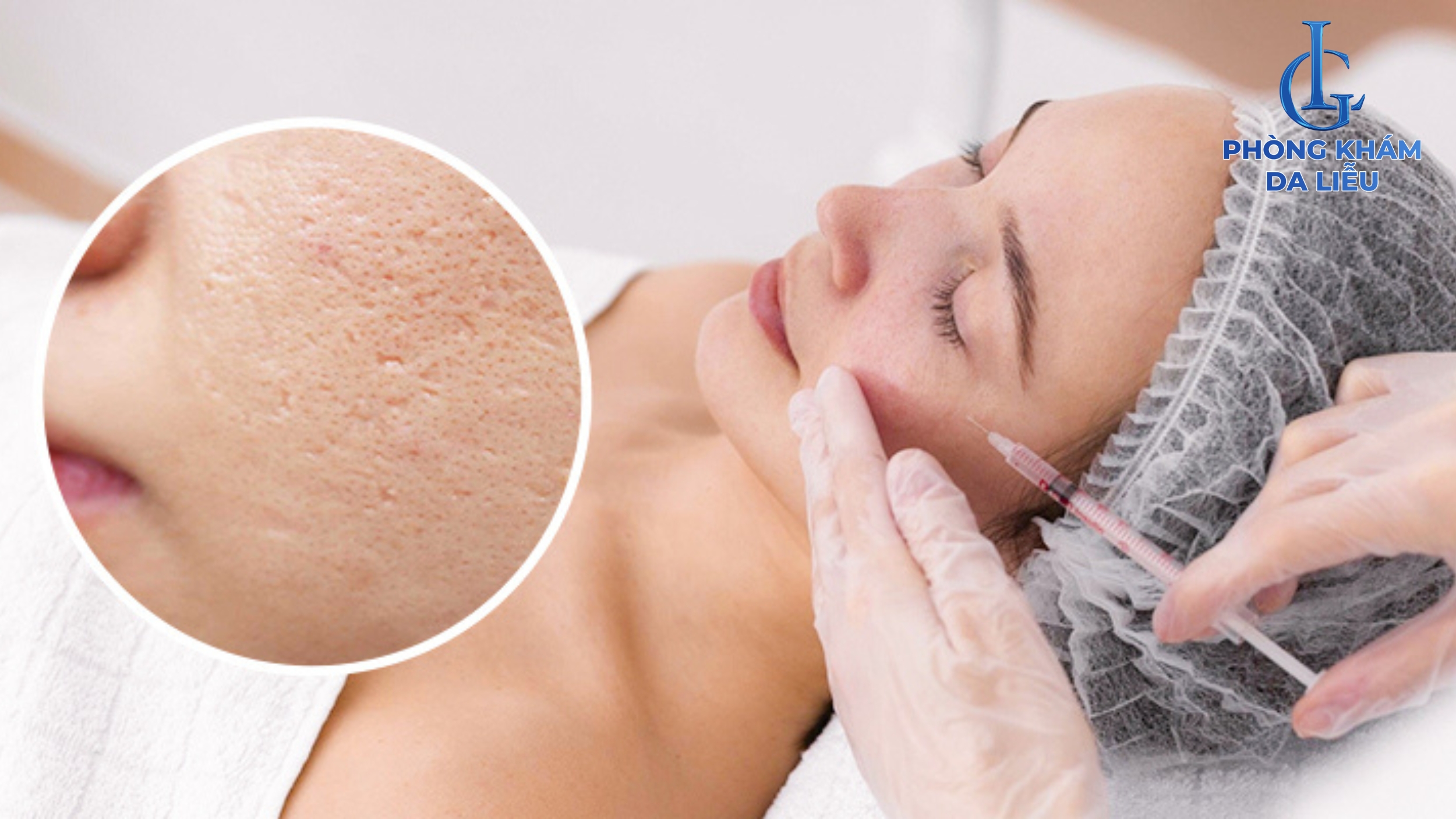 mesotheraly trị sẹo lõm