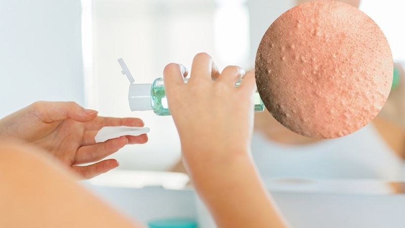 skincare cho da dầu mụn ẩn vào buổi sáng