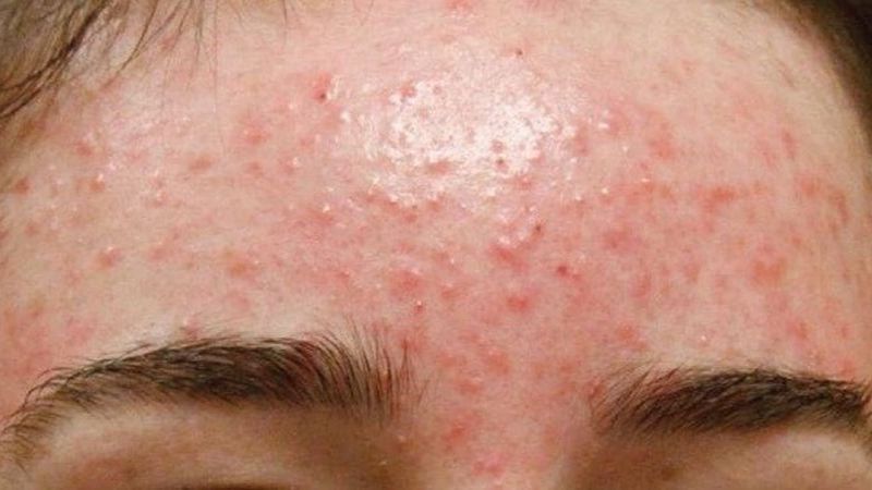 mụn ẩn đẩy lên ở trán